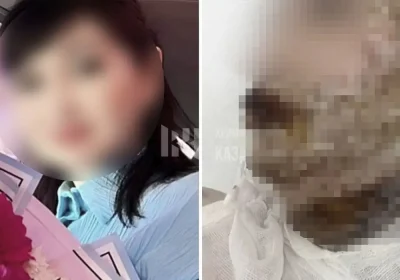 Әйел ауыр жарақат алған: Шымкентте ер адам экс-жұбайының бетіне қышқыл шашқан